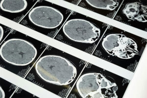 Malattie metaboliche infantili: l’interessamento del sistema nervoso è molto comune
