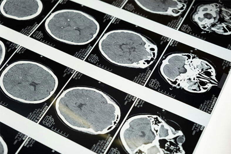 Malattie metaboliche infantili: l’interessamento del sistema nervoso è molto comune